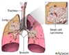سرطان ریه ی سلول کوچک چیست؟